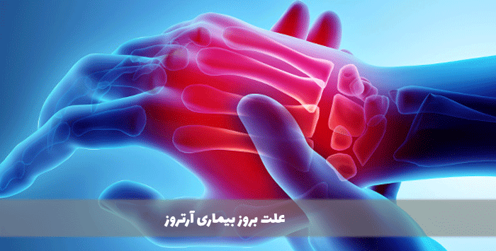 علت بروز بیماری آرتروز