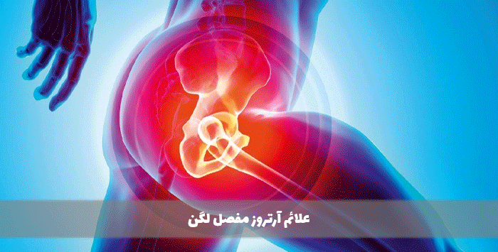 علائم آرتروز مفصل لگن