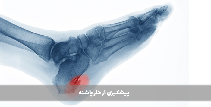 پیشگیری از خار پاشنه