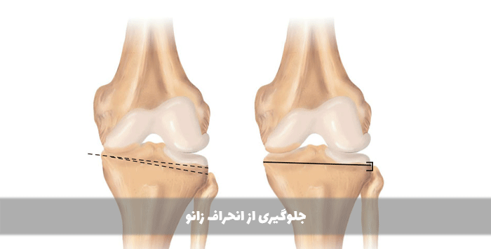 جلوگیری از انحراف زانو