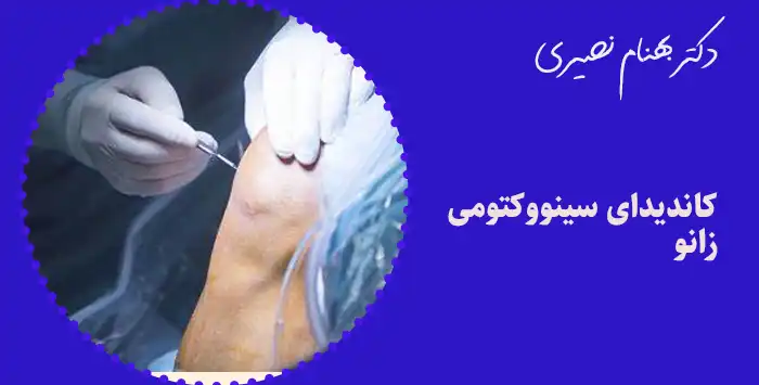 کاندیدای سینووکتومی زانو