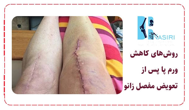 روش‌های کاهش ورم پا پس از تعویض مفصل زانو