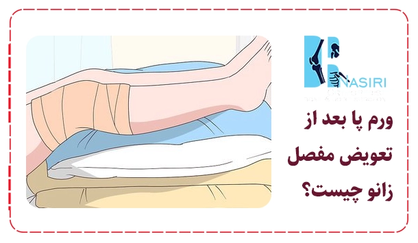 ورم پا بعد از تعویض مفصل زانو چیست؟